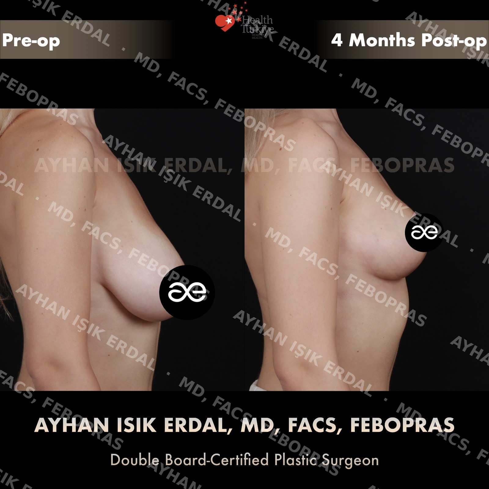 Breast lift before and after — autologous mastopexy, lateral view, 4 months post-op