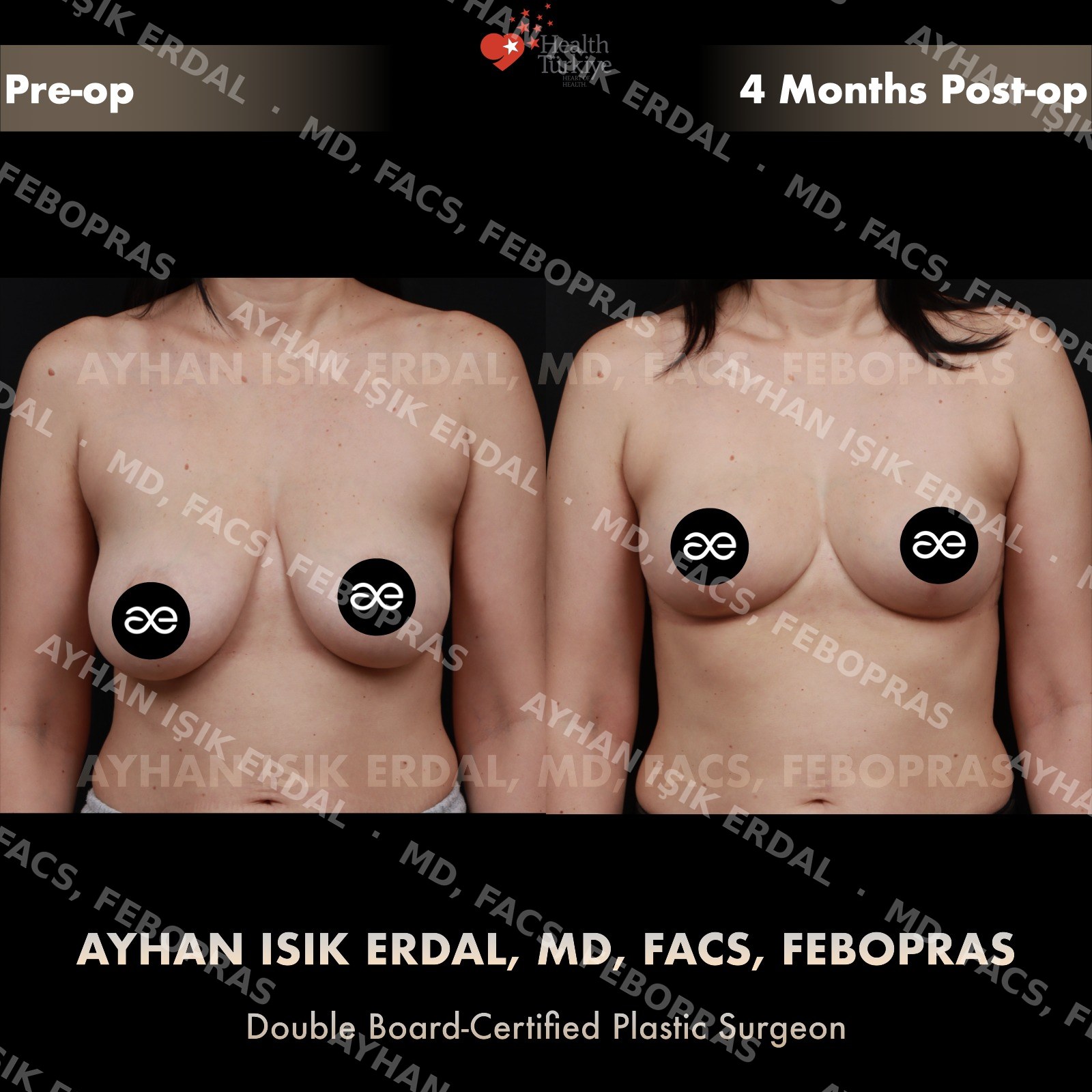 Breast lift before and after — autologous mastopexy, frontal view, 4 months post-op