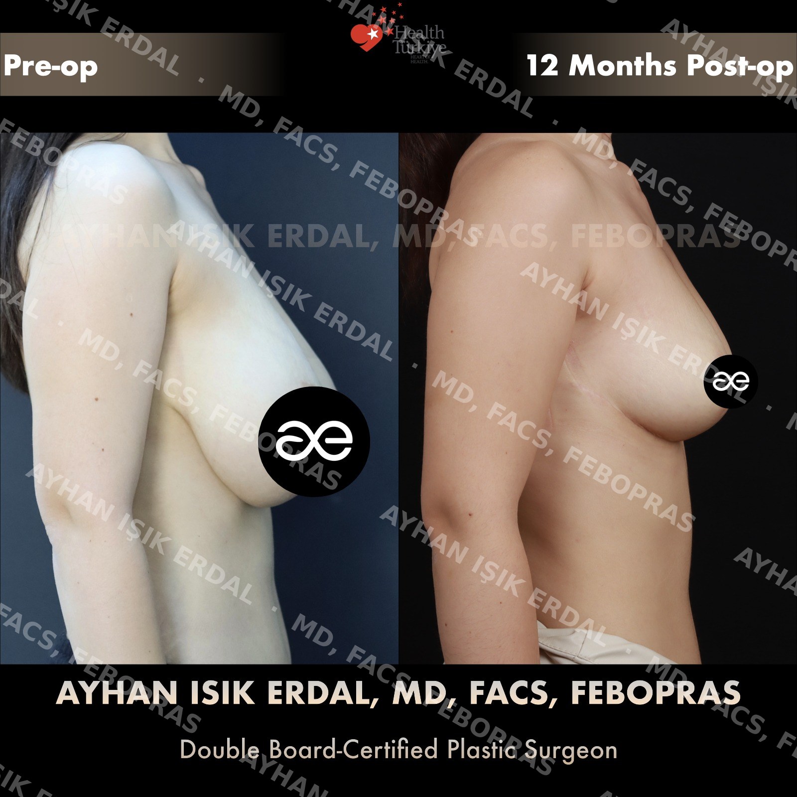 Breast lift before and after — autologous reduction-mastopexy, lateral view, 12 months post-op