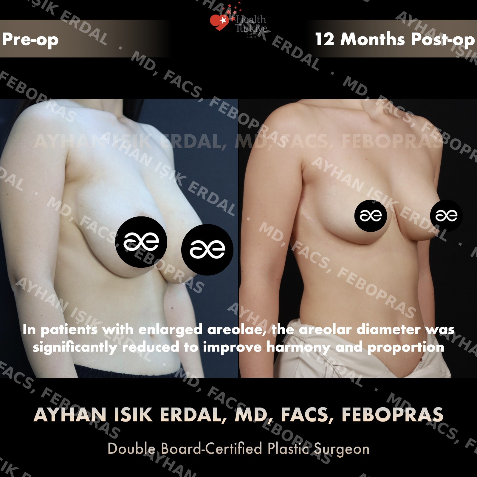 Breast lift before and after — autologous reduction-mastopexy, oblique view, 12 months post-op