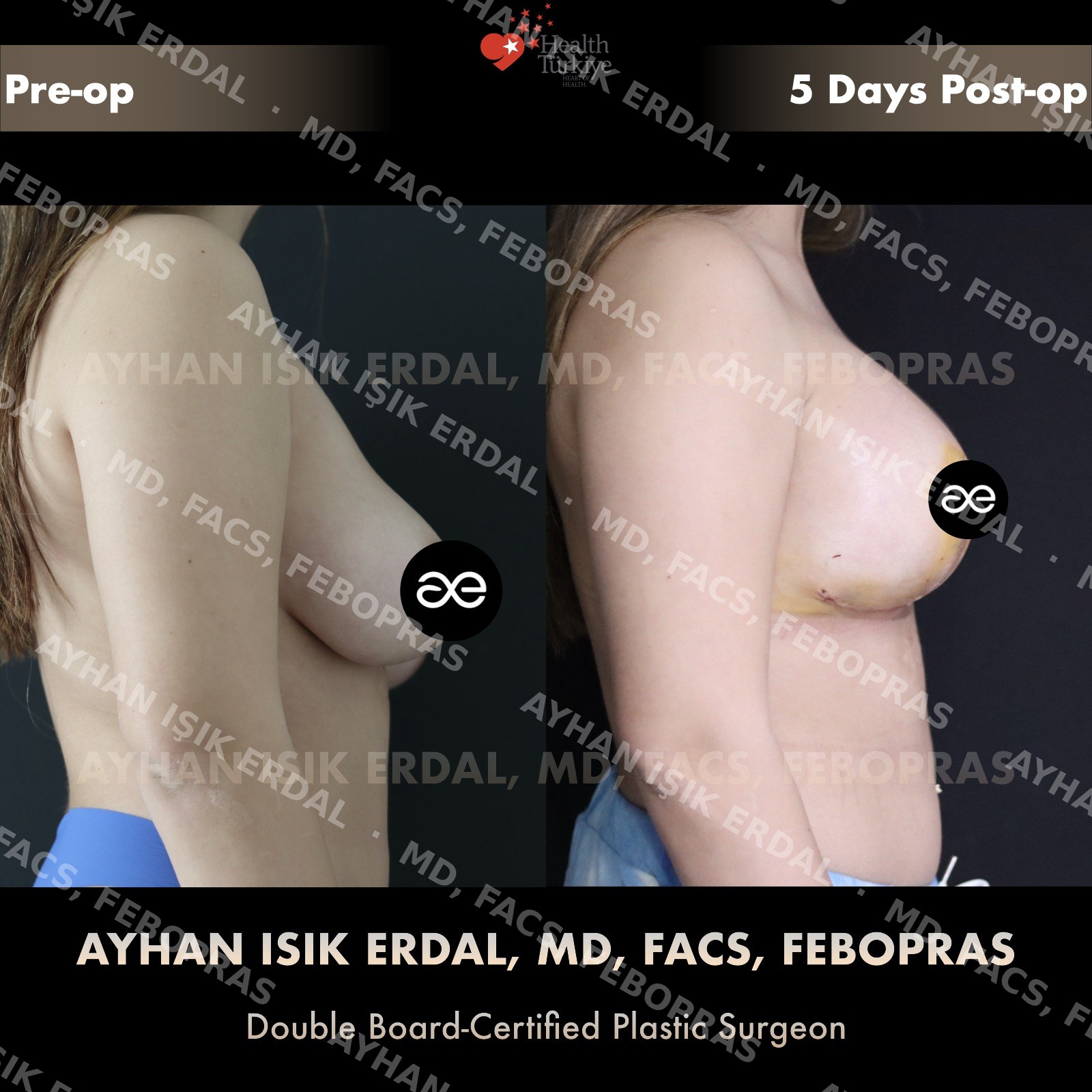 Augmentation-mastopexy with round implant, lateral view, 5 days post-op